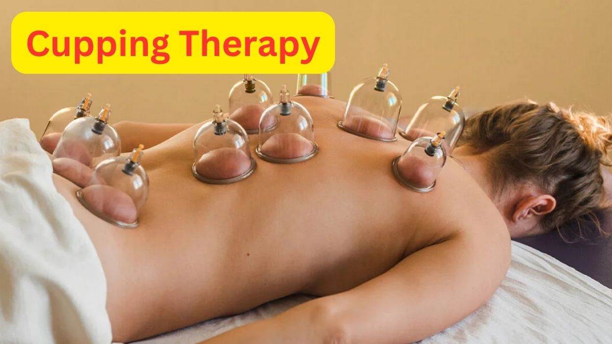 Cupping Therapy कपग थरप लन स पहल जन इसक फयद और नकसन