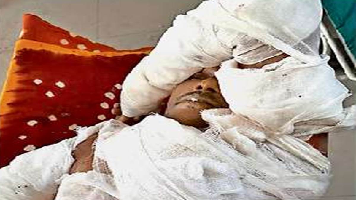 Gwalior News: सिलेंडर फटने से झुलसे अवधेश ने भी दम तोड़ा