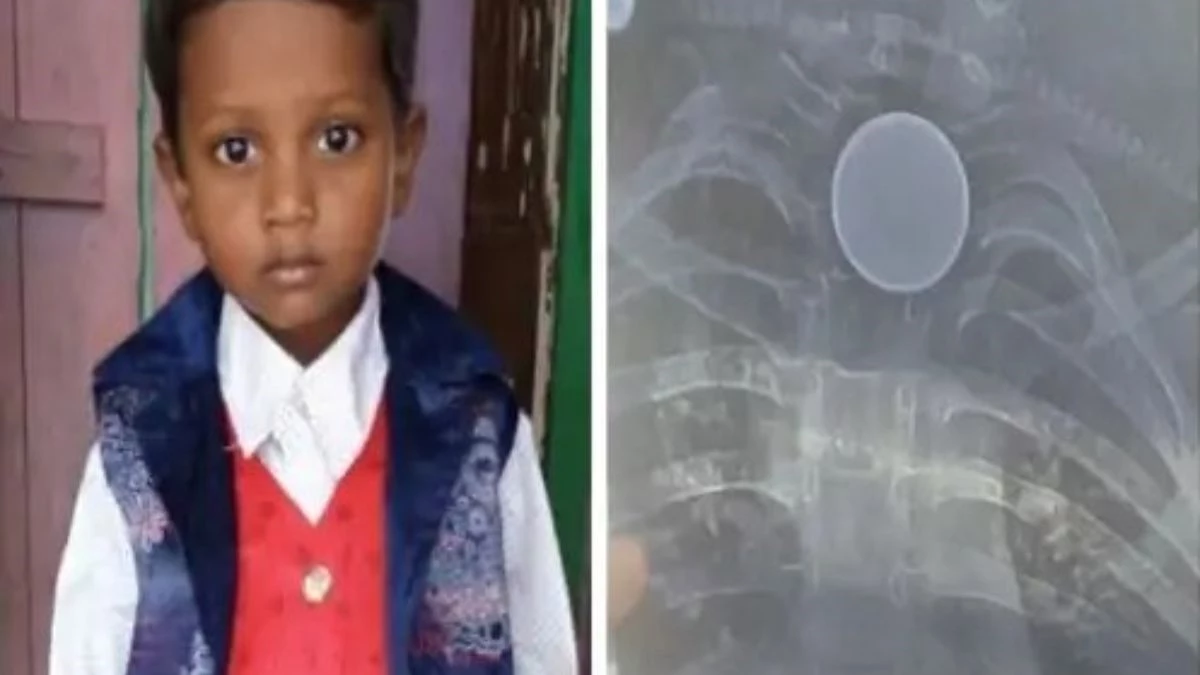 कोरबा में एक्स-रे में दिखा सिक्का जैसा गोला, इलाज शुरू होने से पहले मासूम की मौत