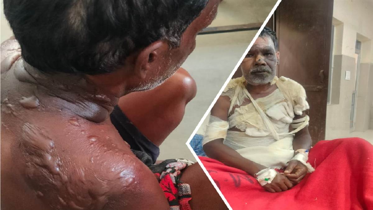 पत्नी बनाकर बेचती थी महुआ शराब, पति को था नापसंद, विवाद के बाद उड़ेल दिया गर्म माढ़