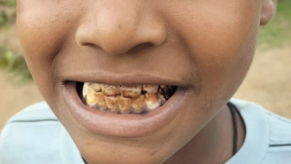 खंडवा के गांवों में फ्लोराइड ने पीले किए युवाओं के दांत, एसडीएम भी रह गए हैरान