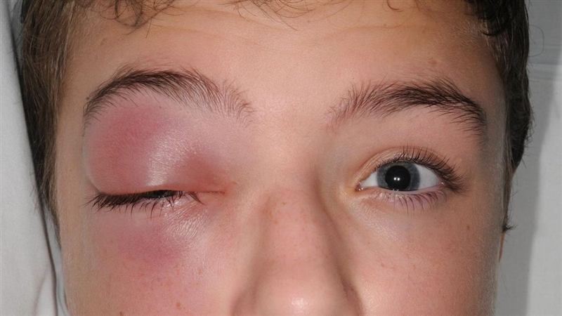 What Causes Swelling In The Eyes