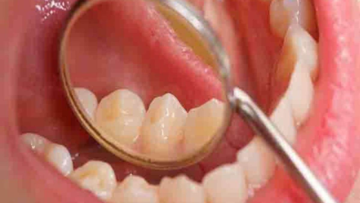 ग्वालियर में 40 फीसदी तक पहुंचा ओरल कैंसर का आंकड़ा, पूरी दुनिया के मुकाबले...