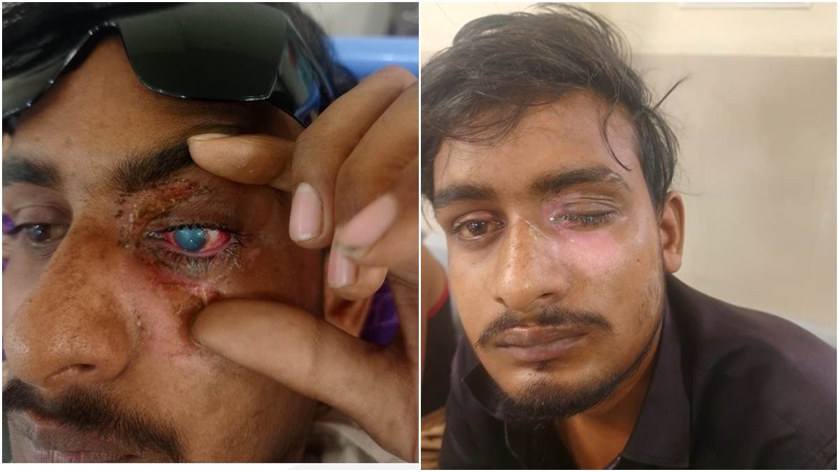 कार्बाइड गन से आंखों में आई गंभीर चोट, रोशनी बचाने के लिए लगाई गर्भनाल की झिल्ली