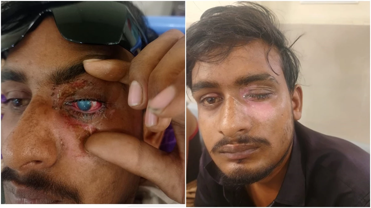 कार्बाइड गन से आंखों में आई गंभीर चोट, रोशनी बचाने के लिए लगाई गर्भनाल की झिल्ली