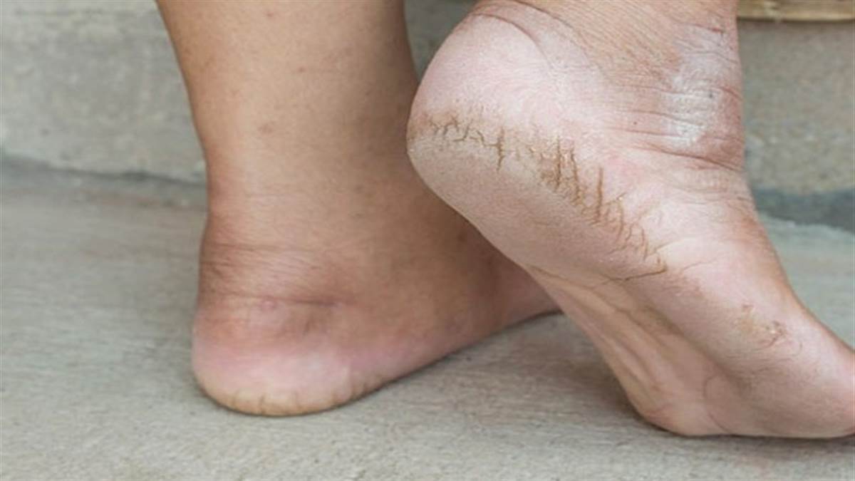 Collapsed Arch Vs Flat Feet: Are They The Same? - Foot And Ankle