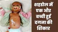 MP News: शहडोल में एक और बीमार बालिका को 24 बार गर्म सलाखों से दागा