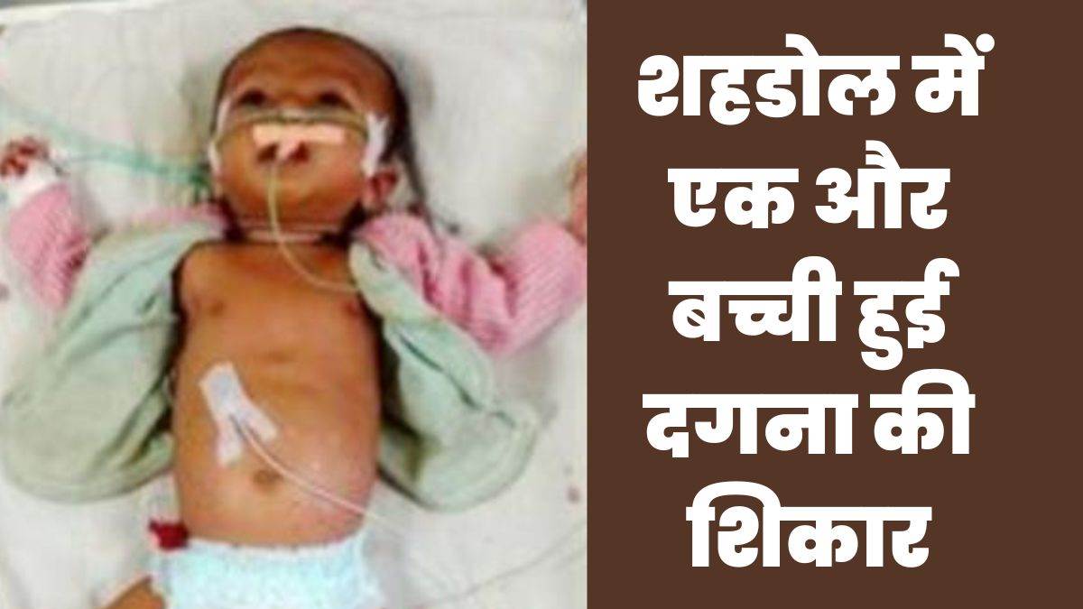 Shahdol News : 24 बार गर्म सलाखों से दागने के बाद एक और निमोनिया पीड़ित बच्ची की मौत