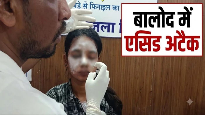 बालोद में लाइब्रेरी से लौट रही युवती पर एसिड अटैक, सिंचाई कॉलोनी की घटना, हमलावर का सुराग नहीं