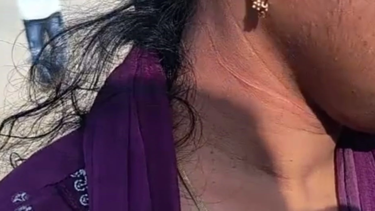 बड़वानी में स्कूटी सवार महिला के गले में अटका चाइनीज मांझा, घायल