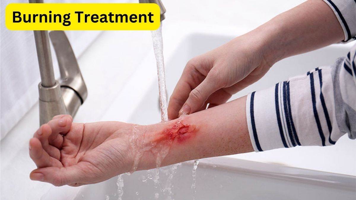 काम की खबर स्किन जलने के बाद तत्काल आजमाएं ये घरेलू उपाय, मिलेगी राहत