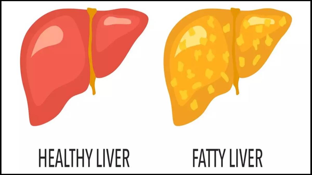 Fatty Liver की समस्या है तो तत्काल बदल दें खानपान की ये आदत, जानें हर