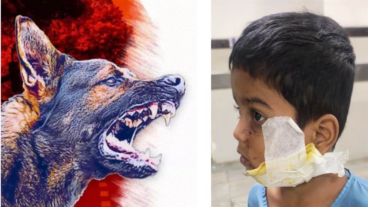 आवारा कुत्ते ने 5 साल के बच्चे का गाल नोंचा, सुपर स्पेशियलिटी में 1 घंटे चली सर्जरी, चेहरे पर आए 20 टांके