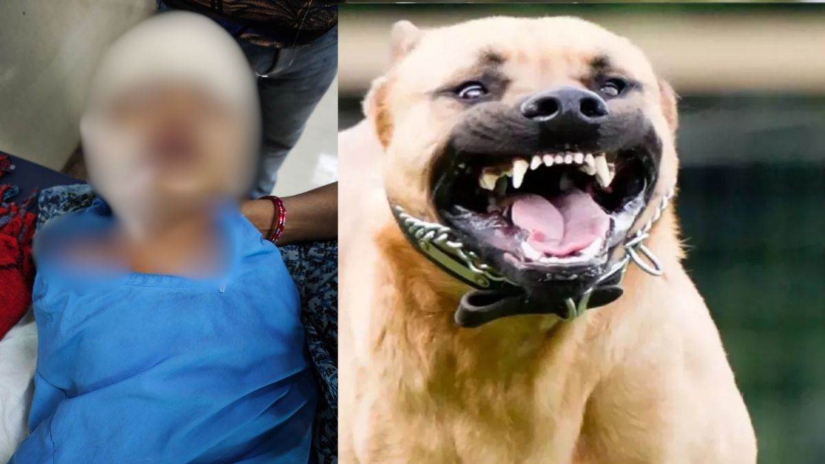 कुत्ते ने 3 साल की बच्ची को काटा... माथे की खाल चबाई, होठ व गाल भी नहीं छोड़े; 150 टांके आए