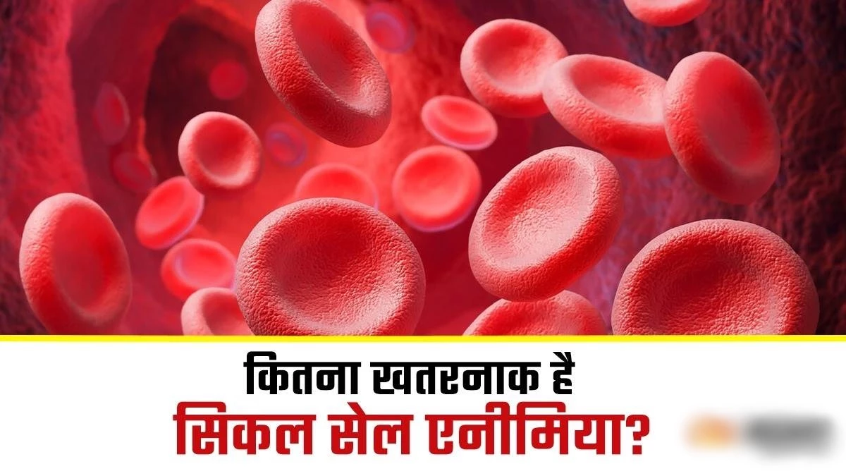 अनुवांशिक बीमारी ने फैला रखी जड़... धार जिले में छात्रावास के 17 नव प्रवेशी सिकल सेल से पीड़ित