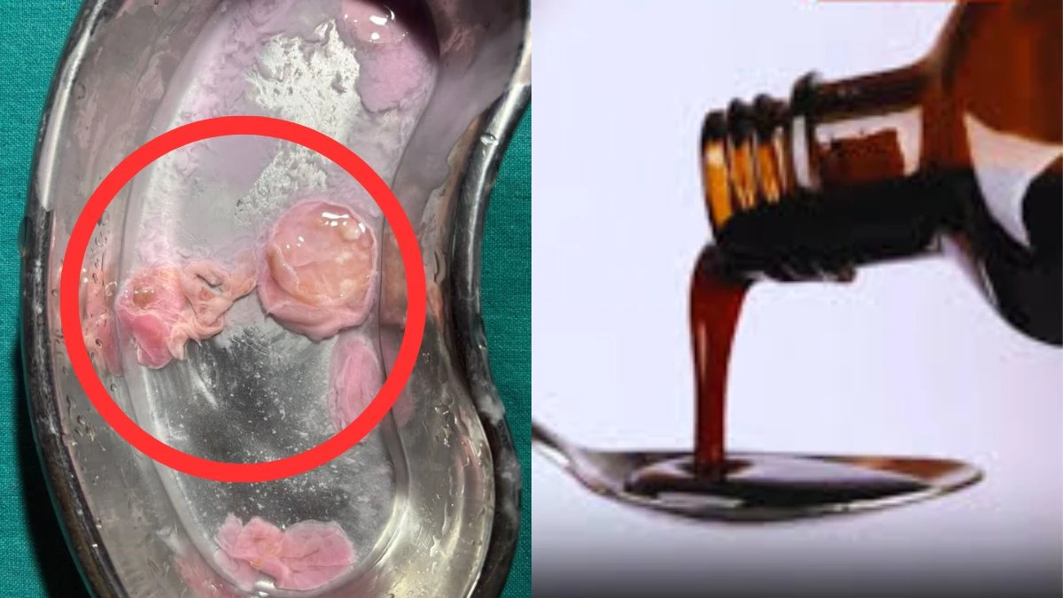 CG News: PHC से मिले कैलसिड सिरप की बोतल से निकला मांस जैसा संदिग्ध टुकड़ा, दवाओं की गुणवत्ता पर उठा सवाल