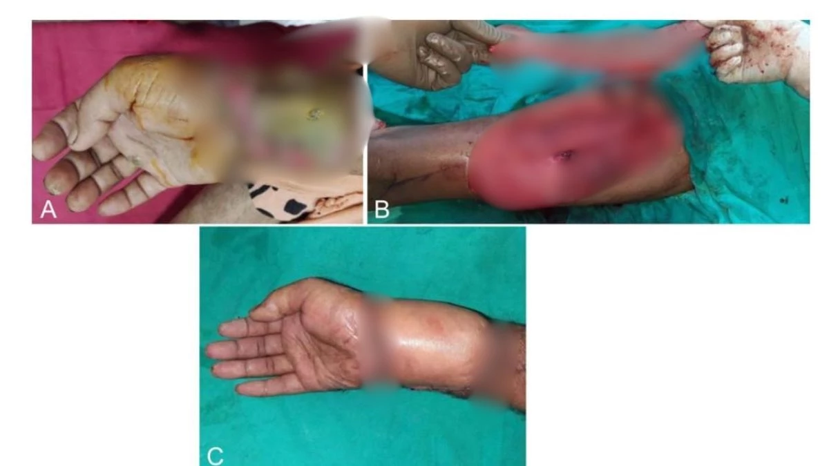 अब घातक करंट से घायल होने के बाद भी नहीं गंवाना पड़ेगा हाथ-पैर, एम्स भोपाल में डॉक्टरों ने खोजा खास तकनीक का इलाज