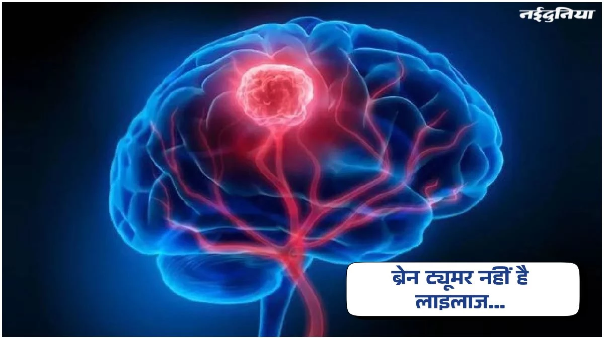 Brain Tumor: अब लाइलाज नहीं रहा ब्रेन ट्यूमर, नई तकनीक से संभव हो रहा सफल इलाज...लोग भी हो रहे हैं जागरूक