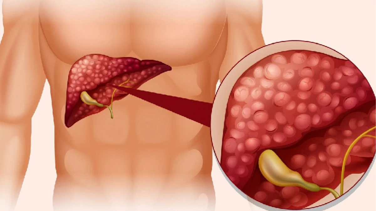 ये 5 लोग हो सकते हैं Liver Cancer का शिकार, शरीर के इन लक्षणों को भूलकर भी न करें नजरअंदाज