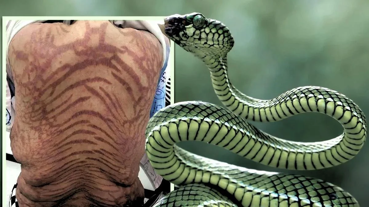 ऑनलाइन क्रीम खरीदना पड़ा भारी, पूरे शरीर पर बने सांप जैसे निशान, महिला का हुआ बुरा हाल