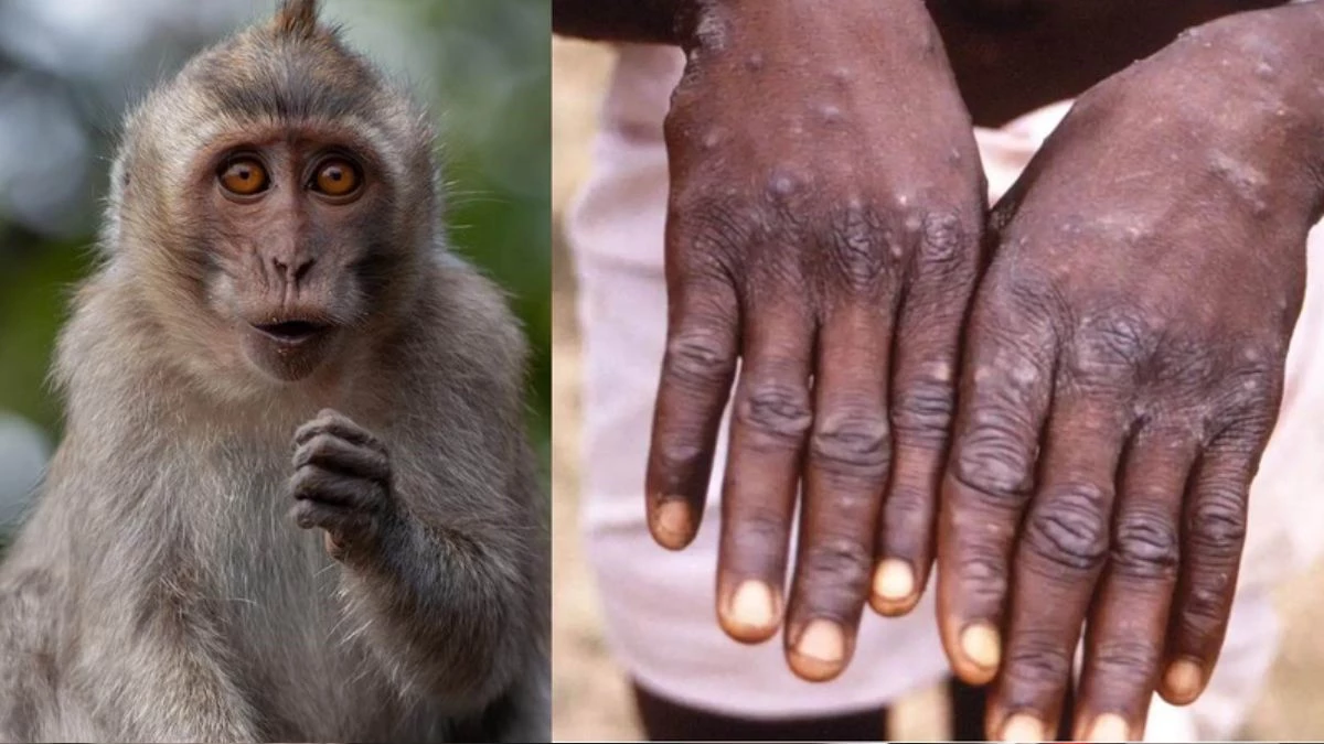 Monkeypox: भारत में मंकीपॉक्स का खतरा, मिला पहला केस; पढ़ें संक्रमित होने पर क्या करें