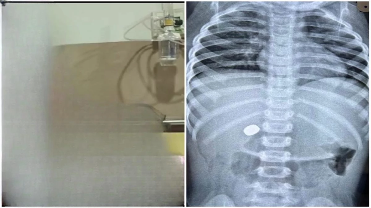 खंडवा में चमत्कार! खेलते समय 10 वर्षीय बच्चे ने निगल लिया घड़ी का सेल, डॉक्टरों ने एंडोस्कोपी से सुरक्षित निकाला