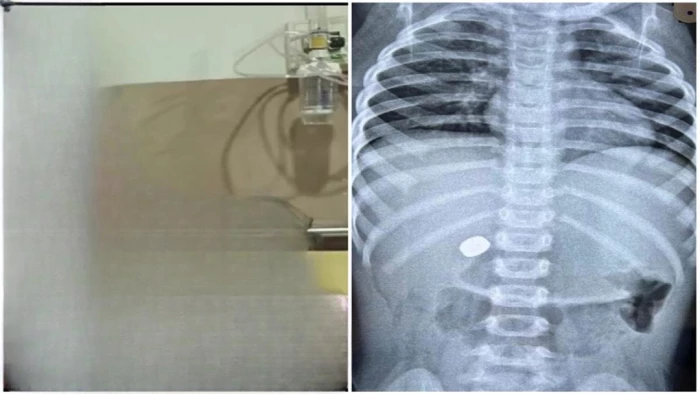 खंडवा में चमत्कार! खेलते समय 10 वर्षीय बच्चे ने निगल लिया घड़ी का सेल, डॉक्टरों ने एंडोस्कोपी से सुरक्षित निकाला