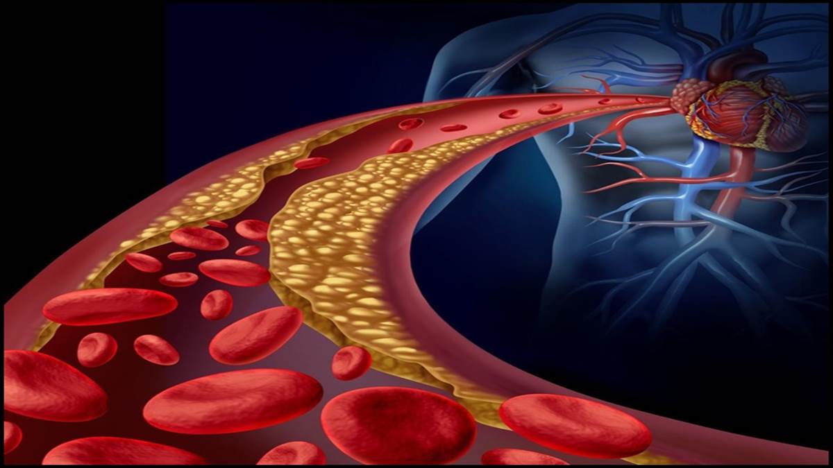 High cholesterol: आपका भी खराब कोलेस्ट्रॉल बढ़ा है तो रोज खाएं ये 5 फल, जल्द कम होगा LDL