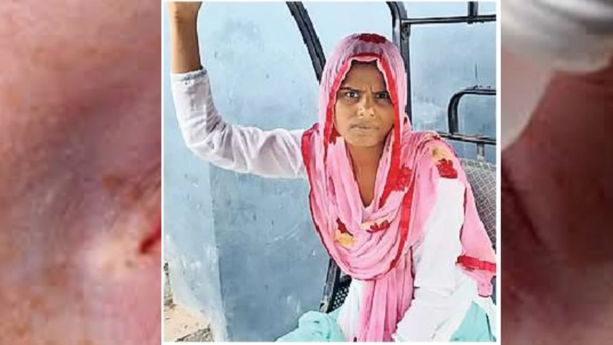 Feviquick in eyes: विवाद के दौरान युवती की आंख में डाल दिया था फेवीक्विक… कम हुई रोशनी, पिता मांग रहे मनौती