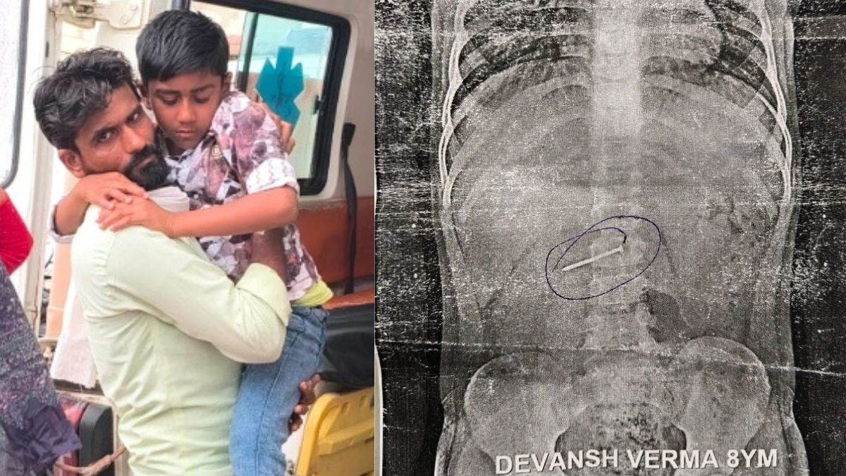 बैतूल में खेलते-खेलते दो इंच लंबी कील निगल गया 8 साल का मासूम, भोपाल में विशेषज्ञों की निगरानी में होगा इलाज