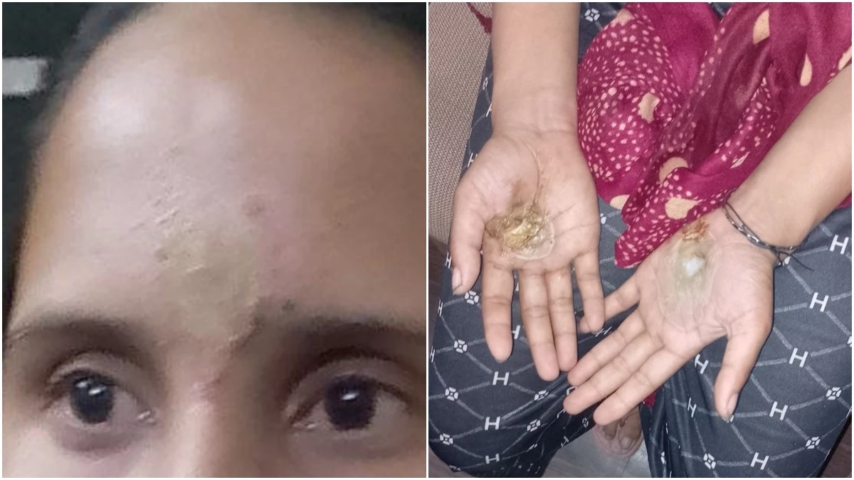 अंधविश्वास की हद, प्रेतबाधा बताकर महिला के दोनों हाथ जला दिए, फिर गर्म सिक्का सिर पर रखकर दाग दिया