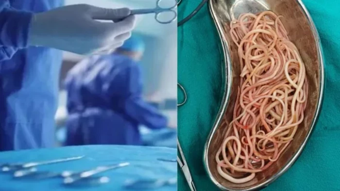बच्ची के पेट में सैकड़ों कीड़े देख डॉक्टर भी रह गए हैरान, सर्जरी से बची जान, पेरेंट्स को चेतावनी