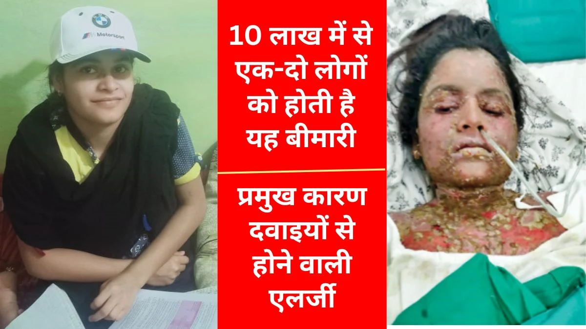 Stevens Johnson Syndrome: अत्यंत दुर्लभ स्टीवंस-जॉनसन सिंड्रोम से इंदौर में 22 साल की युवती की मौत, परिजन समझते रहे त्वचा संबंधी बीमारी