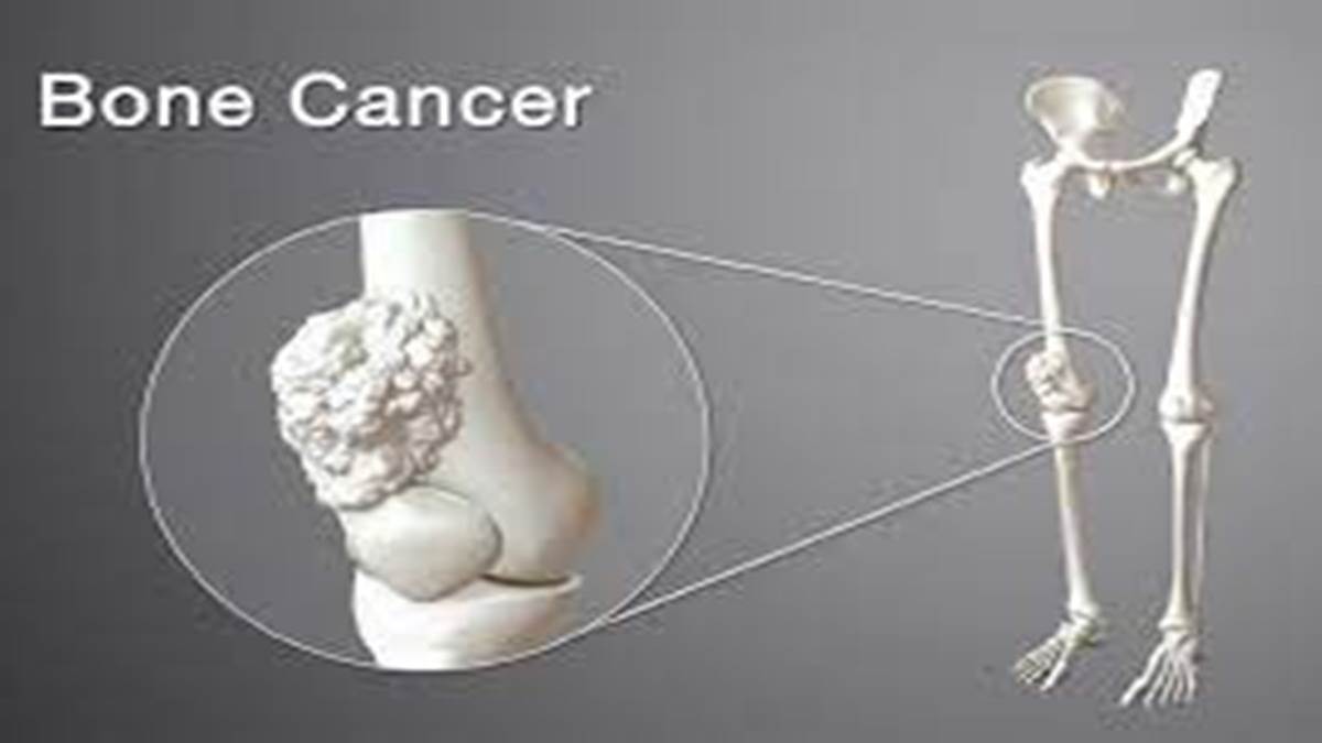 Bone Cancer शरीर में दर्द तो हल्के में न लें बोन कैंसर का कारण बन सकता Bone Cancer Do Not