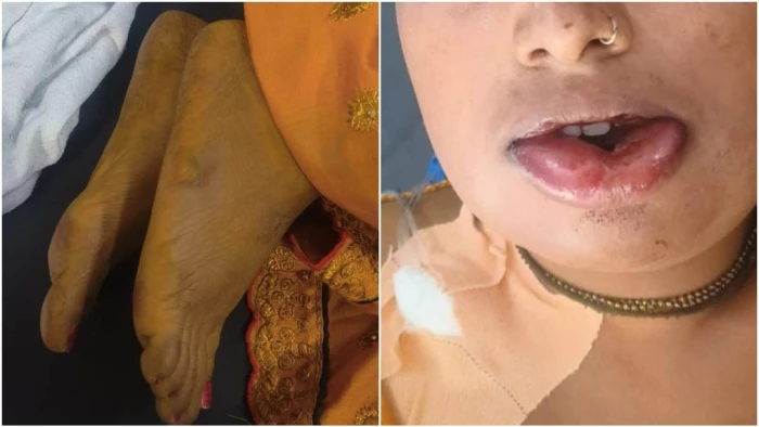 जहरीली हल्दी से सावधान! शादी से पहले दुल्हन ने लगाई तो फूलने लगा चेहरा; अचानक हुई मौत