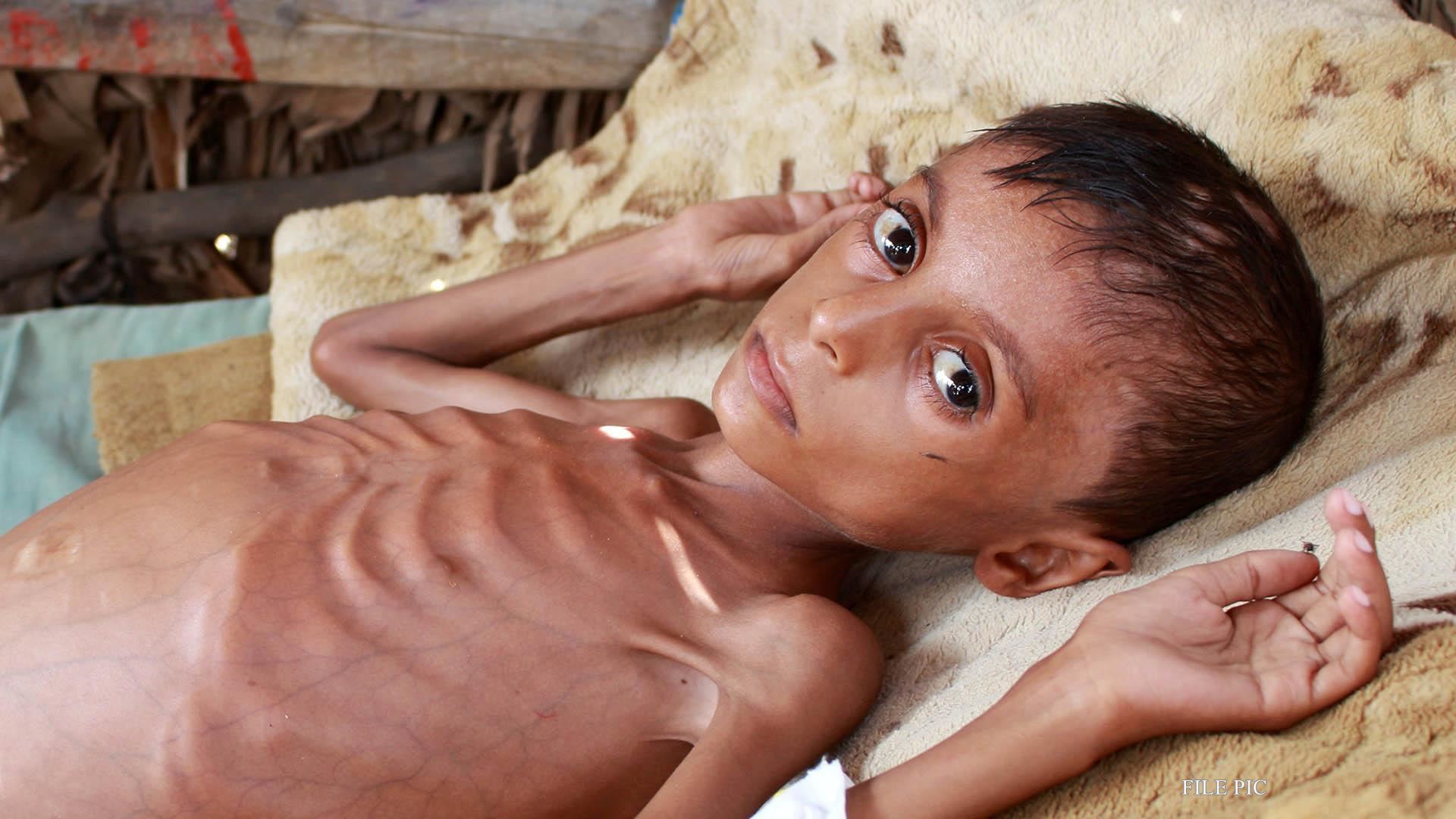 छत्तीसगढ़: कुपोषण से बच्चों की हो रही मौत पर भाजपा ने राज्य सरकार को घेरा