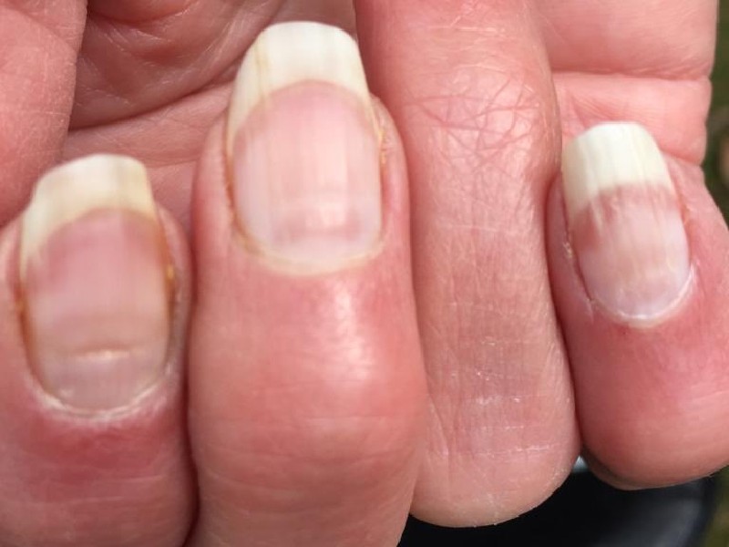 Alert: क्या कोरोना का लक्षण है नाखूनों में दिखने वाली लकीरें, जानिए इसका  मतलब - Alert dose visible streaks in the nails are symptoms of corona what  dose these nails indicate