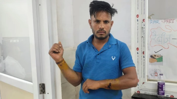 ग्वालियर में 2 साल के बच्चे पर झपटा आवारा कुत्ता, मासूम को बचाने में लहूलुहान हुआ युवक