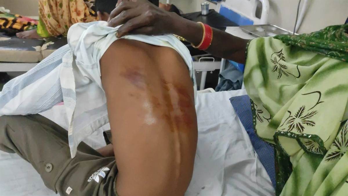 बालाघाट में शिक्षक की बर्बरता, गणित हल नहीं कर सका तो पांचवीं के छात्र की कर दी पिटाई; पीठ पर पड़े निशान