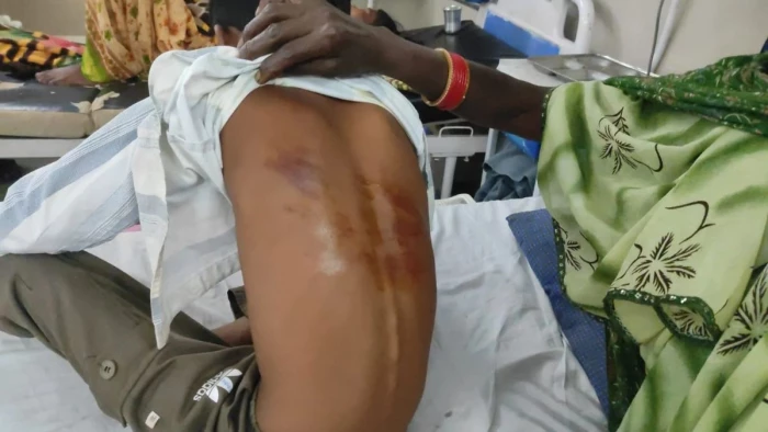 बालाघाट में शिक्षक की बर्बरता, गणित हल नहीं कर सका तो पांचवीं के छात्र की कर दी पिटाई; पीठ पर पड़े निशान