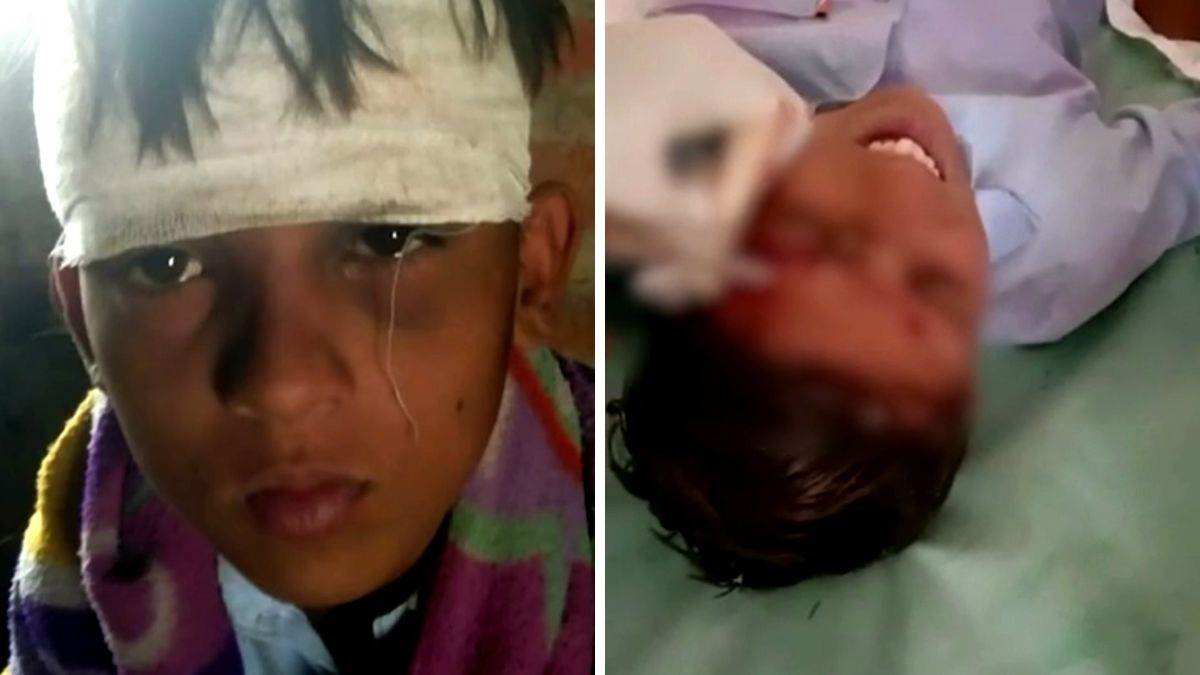 Jodhpur: सरकारी स्कूल के हेड मास्टर ने आठवीं के छात्र को डंडे से बुरी तरह पीटा, आंख के ऊपर लगे 4 टांके