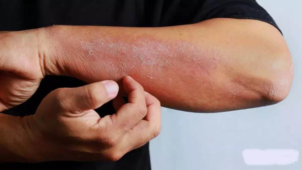 मौसम के साथ त्वचा का PH स्तर बदलने से बढ़ती खुजली व अन्य समस्याएं