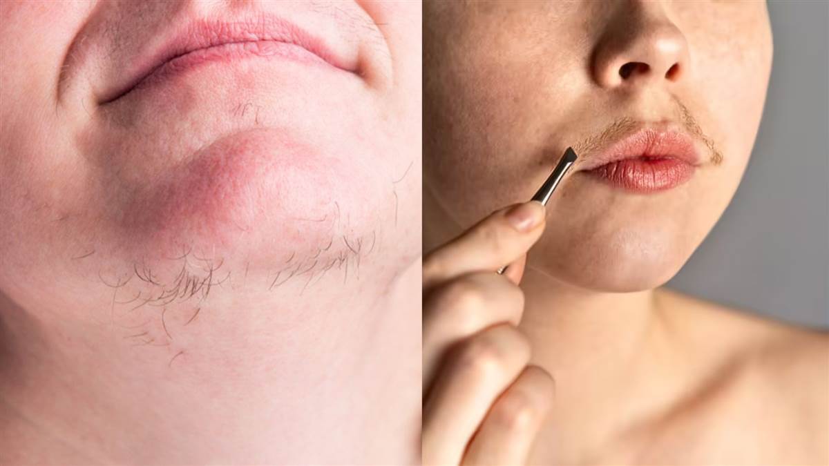 लड़कियों को दाढ़ी-मूंछ क्यों आती हैं? शरीर में इस हार्मोन की मात्रा बढ़ने से निकलते हैं अनचाहे बाल