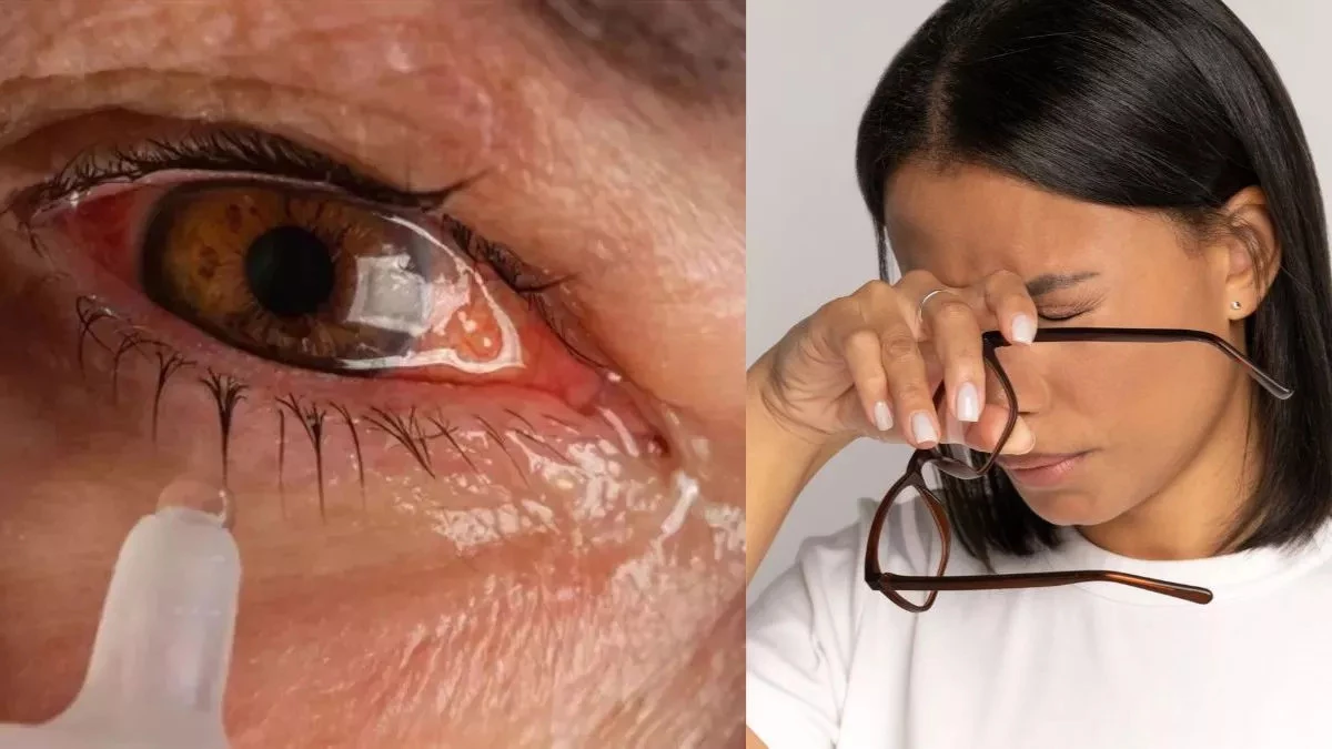 सावधान! तेजी से फैल रहा Eye Flu, ये लक्षण दिखें तो तुरंत डॉक्टर के पास भागें... वरना खराब हो सकती हैं आंखें