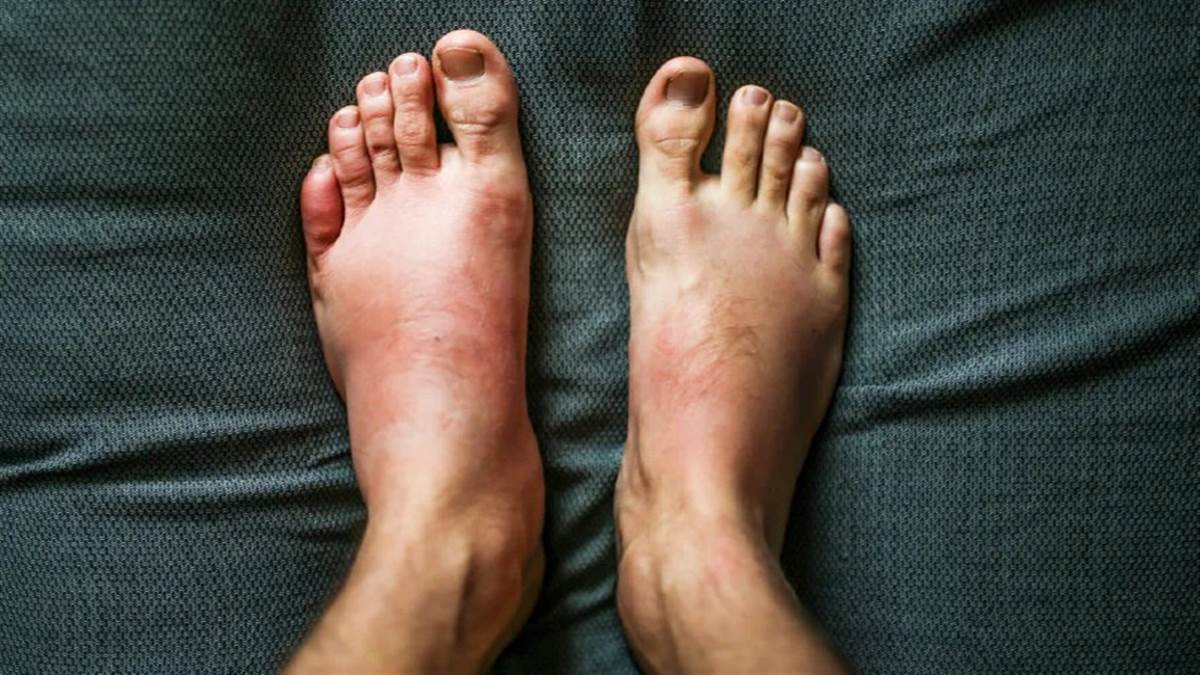 Body Swelling Remedies: Follow these home remedies to reduce swelling in the body, you will get relief soon