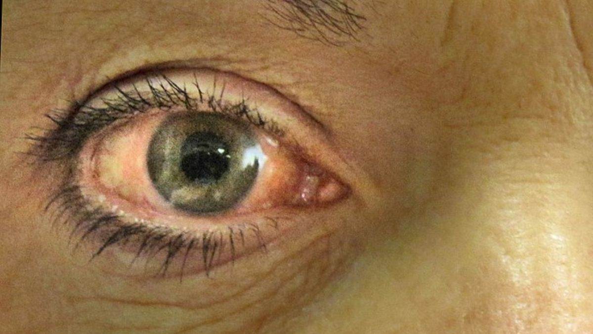Glaucoma: आंखों के लिए खतरनाक है ग्लूकोमा, ये हैं लक्षण और उपचार