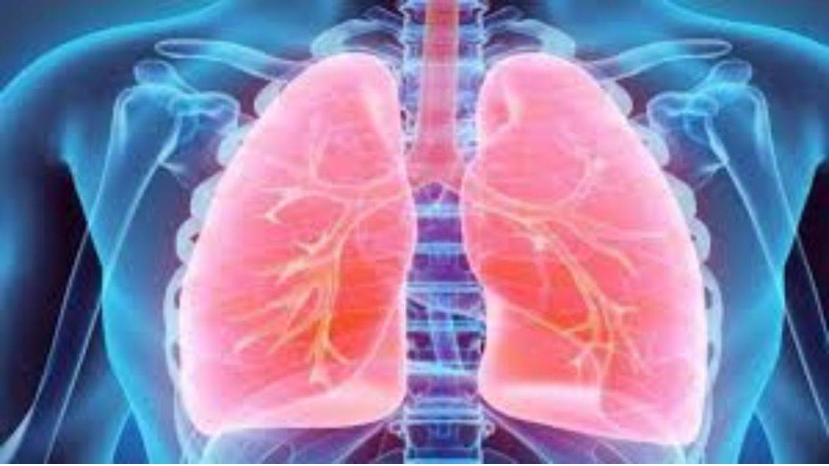 'NO Smoking' वाले भी सावधान: भोपाल में सामने आया फेफड़ों के कैंसर का बेहद रेयर केस, एडवांस तकनीक से बची जान