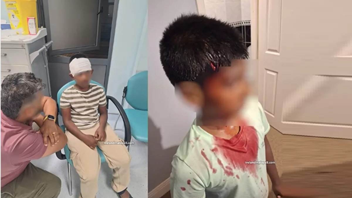 Racial Attack in Ireland: 9 साल के भारतीय मूल के बच्चे पर पत्थर से हमला, अस्पताल में भर्ती