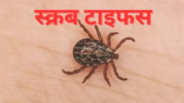छत्तीसगढ़ के जांजगीर में स्वाइन फ्लू के बाद स्क्रब टाइफस का कहर: तुसमा के युवक ने बिलासपुर में तोड़ा दम, 5 मरीज भर्ती