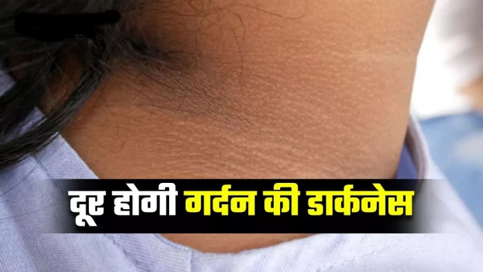 गर्दन पर कालापन, त्वचा में बदलाव टाइप-2 डायबिटीज का हो सकता है संकेत
